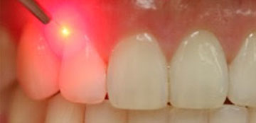 Laserterapia