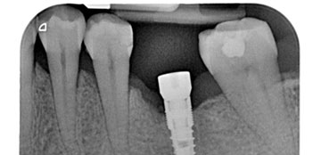 Radiografie Digitali